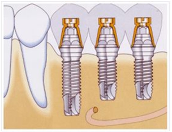 戰(zhàn)“疫”護(hù)牙方法：“坐困家中”，誰(shuí)來(lái)救救我的種植牙？