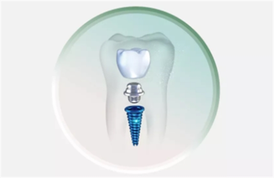 戰(zhàn)“疫”護(hù)牙方法：“坐困家中”，誰(shuí)來(lái)救救我的種植牙？