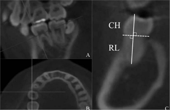 正畸文獻(xiàn)閱讀--生長激素受體基因與人牙齒的根長和牙齒長度有關(guān) 正畸文獻(xiàn)閱讀--生長激素受體基因與人牙齒的根長和牙齒長度有關(guān)
