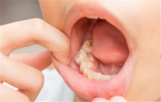 牙間隙過大 牙間隙過大