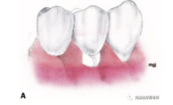 FGG游離牙齦移植在歷史上的各種改良以及發(fā)展前景 FGG游離牙齦移植在歷史上的各種改良以及發(fā)展前景