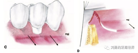 FGG游離牙齦移植在歷史上的各種改良以及發(fā)展前景 FGG游離牙齦移植在歷史上的各種改良以及發(fā)展前景