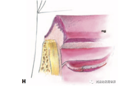 FGG游離牙齦移植在歷史上的各種改良以及發(fā)展前景 FGG游離牙齦移植在歷史上的各種改良以及發(fā)展前景