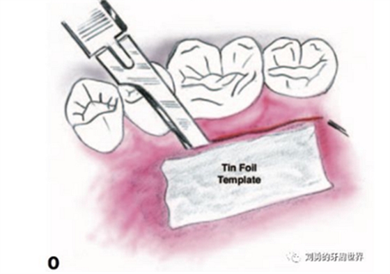 FGG游離牙齦移植在歷史上的各種改良以及發(fā)展前景 FGG游離牙齦移植在歷史上的各種改良以及發(fā)展前景