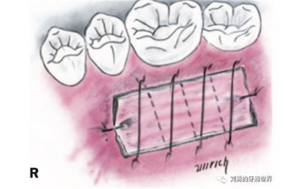 FGG游離牙齦移植在歷史上的各種改良以及發(fā)展前景 FGG游離牙齦移植在歷史上的各種改良以及發(fā)展前景