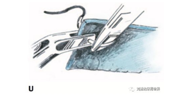 FGG游離牙齦移植在歷史上的各種改良以及發(fā)展前景 FGG游離牙齦移植在歷史上的各種改良以及發(fā)展前景