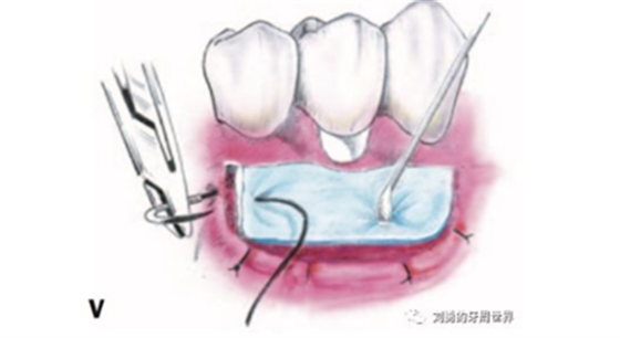 FGG游離牙齦移植在歷史上的各種改良以及發(fā)展前景 FGG游離牙齦移植在歷史上的各種改良以及發(fā)展前景