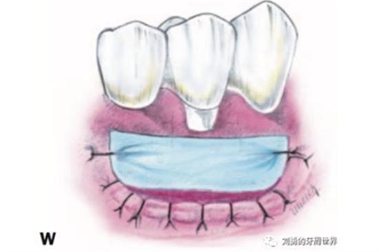 FGG游離牙齦移植在歷史上的各種改良以及發(fā)展前景 FGG游離牙齦移植在歷史上的各種改良以及發(fā)展前景