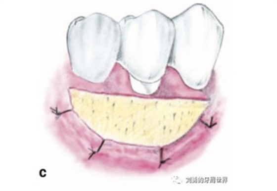 FGG游離牙齦移植在歷史上的各種改良以及發(fā)展前景 FGG游離牙齦移植在歷史上的各種改良以及發(fā)展前景