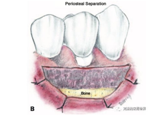 FGG游離牙齦移植在歷史上的各種改良以及發(fā)展前景 FGG游離牙齦移植在歷史上的各種改良以及發(fā)展前景