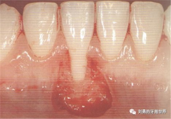 FGG游離牙齦移植在歷史上的各種改良以及發(fā)展前景 FGG游離牙齦移植在歷史上的各種改良以及發(fā)展前景