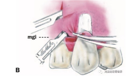 FGG游離牙齦移植在歷史上的各種改良以及發(fā)展前景 FGG游離牙齦移植在歷史上的各種改良以及發(fā)展前景