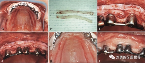 FGG游離牙齦移植在歷史上的各種改良以及發(fā)展前景 FGG游離牙齦移植在歷史上的各種改良以及發(fā)展前景