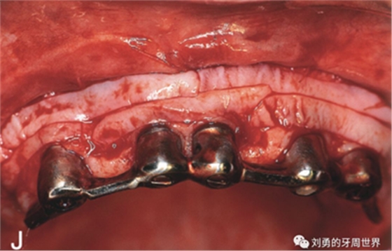 FGG游離牙齦移植在歷史上的各種改良以及發(fā)展前景 FGG游離牙齦移植在歷史上的各種改良以及發(fā)展前景