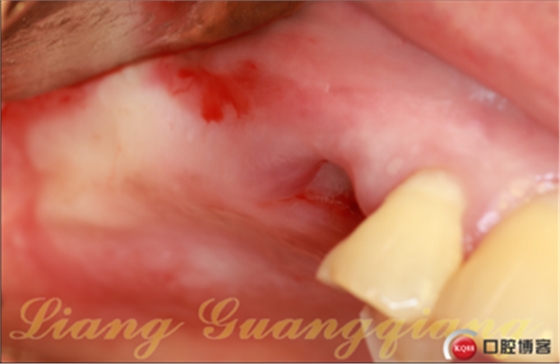 上頜竇外提升術(shù)中對(duì)大囊腫的處理 上頜竇外提升術(shù)中對(duì)大囊腫的處理