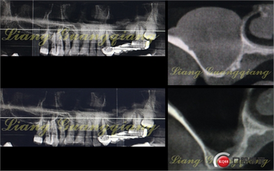 上頜竇外提升術(shù)中對(duì)大囊腫的處理 上頜竇外提升術(shù)中對(duì)大囊腫的處理