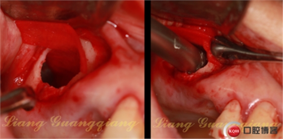 上頜竇外提升術(shù)中對(duì)大囊腫的處理 上頜竇外提升術(shù)中對(duì)大囊腫的處理