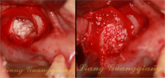 上頜竇外提升術(shù)中對(duì)大囊腫的處理 上頜竇外提升術(shù)中對(duì)大囊腫的處理