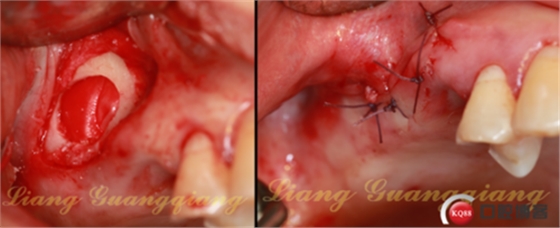 上頜竇外提升術(shù)中對(duì)大囊腫的處理 上頜竇外提升術(shù)中對(duì)大囊腫的處理