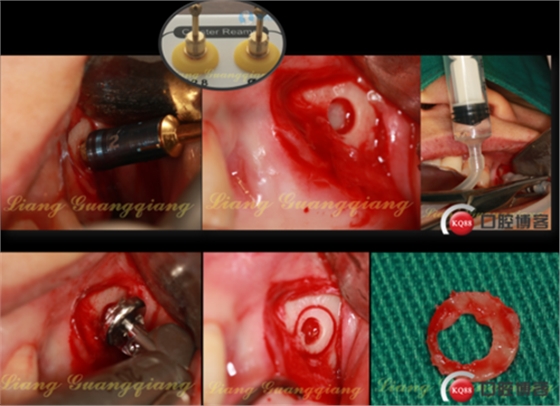 上頜竇外提升術(shù)中對(duì)大囊腫的處理 上頜竇外提升術(shù)中對(duì)大囊腫的處理