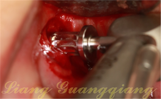 上頜竇外提升術(shù)中對(duì)大囊腫的處理 上頜竇外提升術(shù)中對(duì)大囊腫的處理