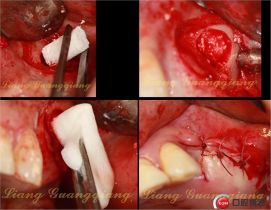 上頜竇外提升術(shù)中對(duì)大囊腫的處理 上頜竇外提升術(shù)中對(duì)大囊腫的處理