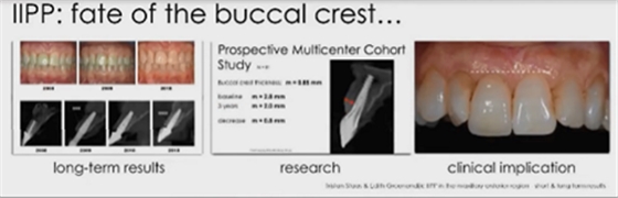即刻種植的成功要素 即刻種植的成功要素