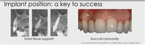 即刻種植的成功要素 即刻種植的成功要素