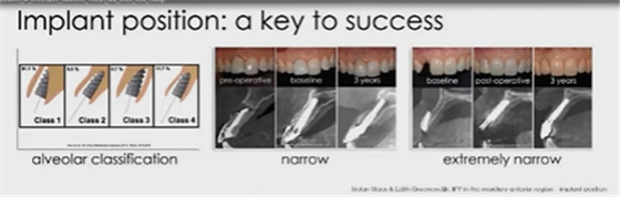 即刻種植的成功要素 即刻種植的成功要素