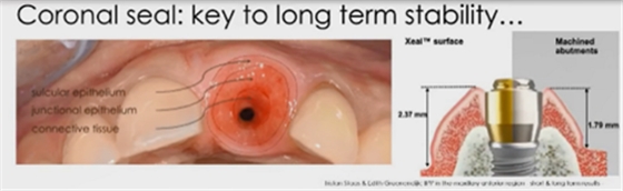 即刻種植的成功要素 即刻種植的成功要素