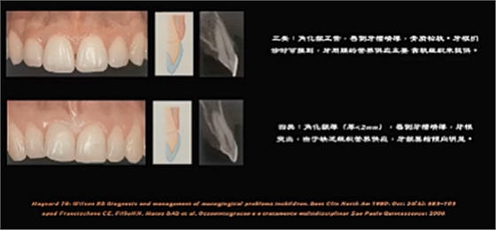 即刻種植的成功要素 即刻種植的成功要素