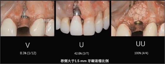 即刻種植的成功要素 即刻種植的成功要素