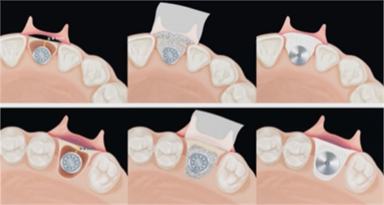 即刻種植的成功要素 即刻種植的成功要素