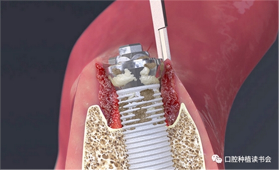 種植體周圍炎的軟硬組織重建治療(上) 種植體周圍炎的軟硬組織重建治療(上)