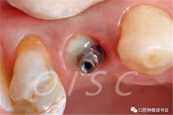 種植體周圍炎的軟硬組織重建治療(上) 種植體周圍炎的軟硬組織重建治療(上)