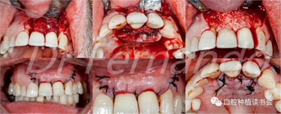 種植體周圍炎的軟硬組織重建治療(上) 種植體周圍炎的軟硬組織重建治療(上)