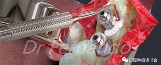 種植體周圍炎的軟硬組織重建治療(上) 種植體周圍炎的軟硬組織重建治療(上)