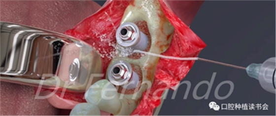 種植體周圍炎的軟硬組織重建治療(上) 種植體周圍炎的軟硬組織重建治療(上)
