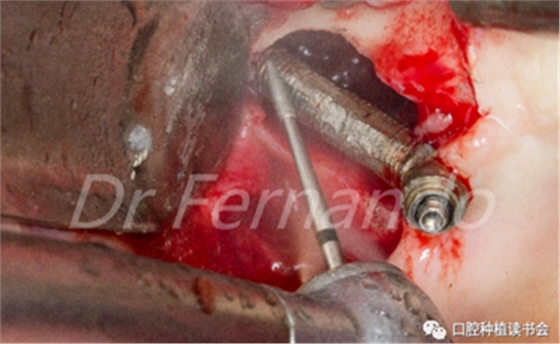 種植體周圍炎的軟硬組織重建治療(上) 種植體周圍炎的軟硬組織重建治療(上)