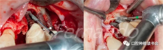 種植體周圍炎的軟硬組織重建治療(下) 種植體周圍炎的軟硬組織重建治療(下)