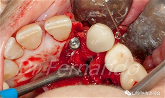 種植體周圍炎的軟硬組織重建治療(下) 種植體周圍炎的軟硬組織重建治療(下)