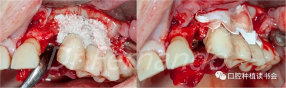 種植體周圍炎的軟硬組織重建治療(下) 種植體周圍炎的軟硬組織重建治療(下)
