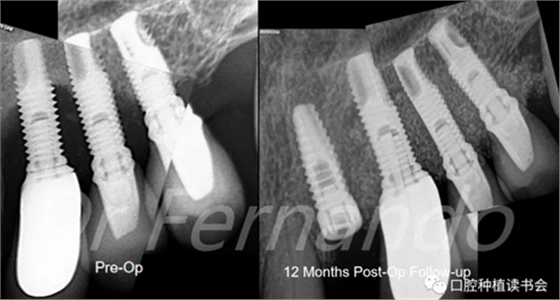 種植體周圍炎的軟硬組織重建治療(下) 種植體周圍炎的軟硬組織重建治療(下)