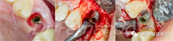 種植體周圍炎的軟硬組織重建治療(下) 種植體周圍炎的軟硬組織重建治療(下)