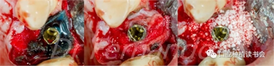 種植體周圍炎的軟硬組織重建治療(下) 種植體周圍炎的軟硬組織重建治療(下)