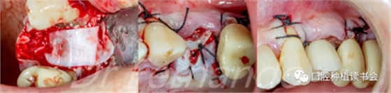 種植體周圍炎的軟硬組織重建治療(下) 種植體周圍炎的軟硬組織重建治療(下)