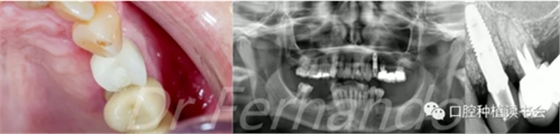 種植體周圍炎的軟硬組織重建治療(下) 種植體周圍炎的軟硬組織重建治療(下)