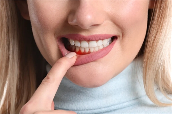 牙周維護(hù) 牙周維護(hù)