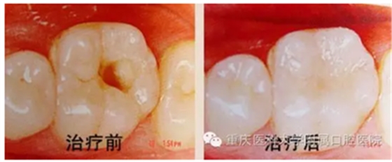 光固化治療 光固化治療