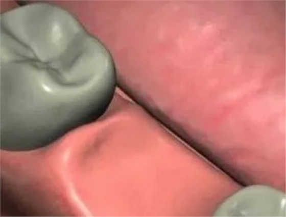 最詳細(xì)的種植牙流程 最詳細(xì)的種植牙流程